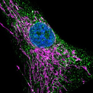 Une mutation génétique rare impliquée dans un déficit immunitaire et affectant la fonction de plusieurs organes