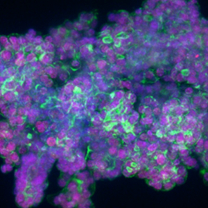 Septembre en or : les tumeurs cérébrales pédiatriques dans le viseur de la recherche