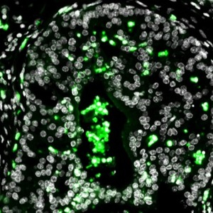Les cellules immunitaires circulantes, une cible contre les métastases dans le cancer de la prostate